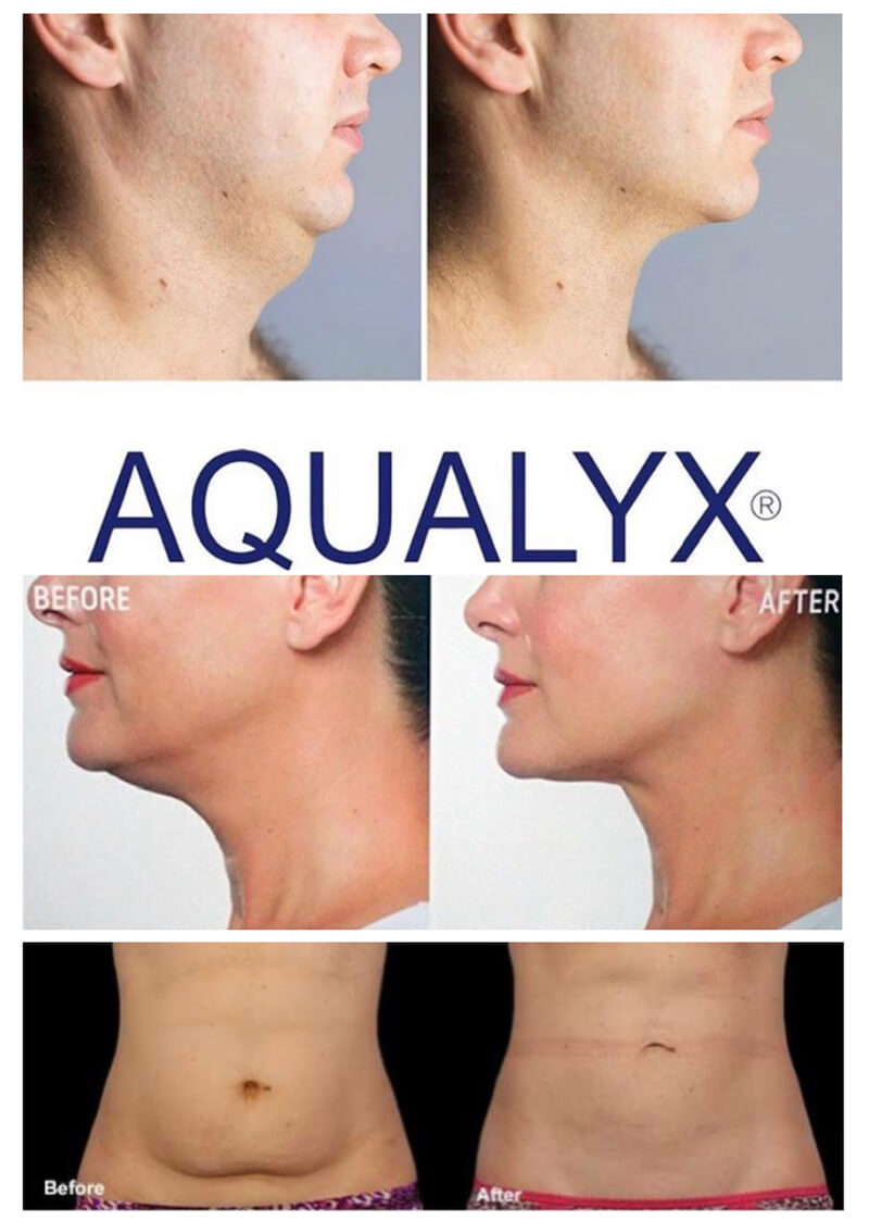 Aqualyx