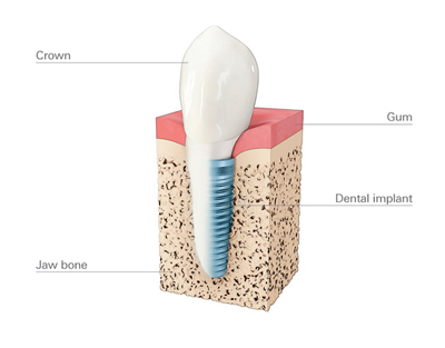 dental-implants
