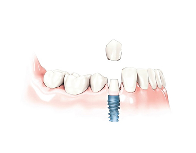 dental-implants