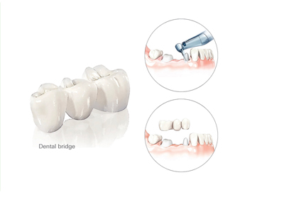 dental-implants