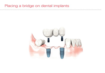 dental-implants
