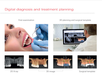 dental-implants